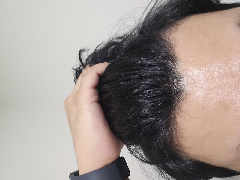 아보다트1년 + 복제약4년 복용중단 2개월차