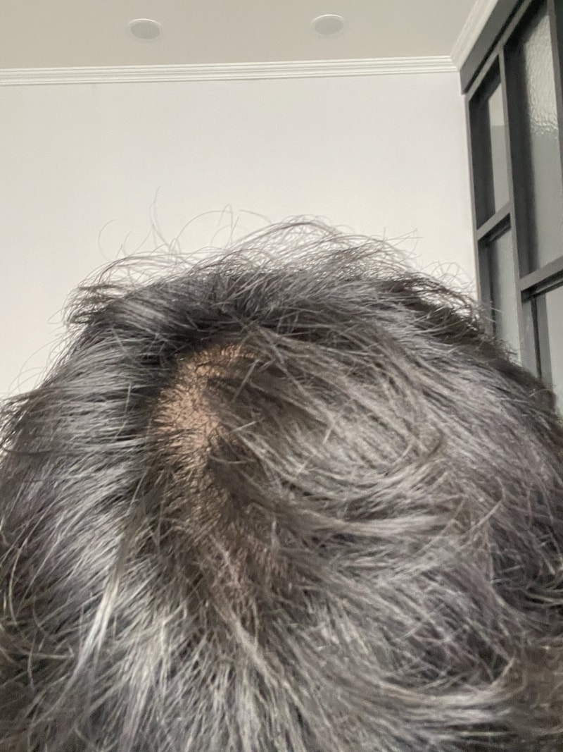 What is my hair loss type
