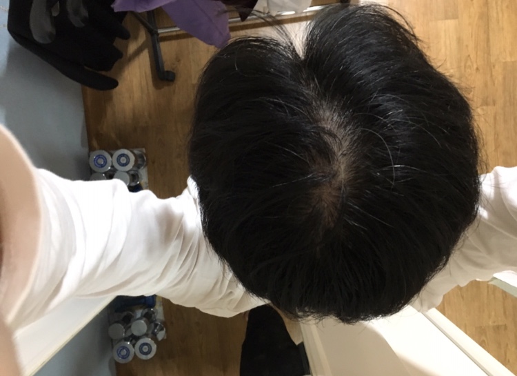 마이녹실 바르기전