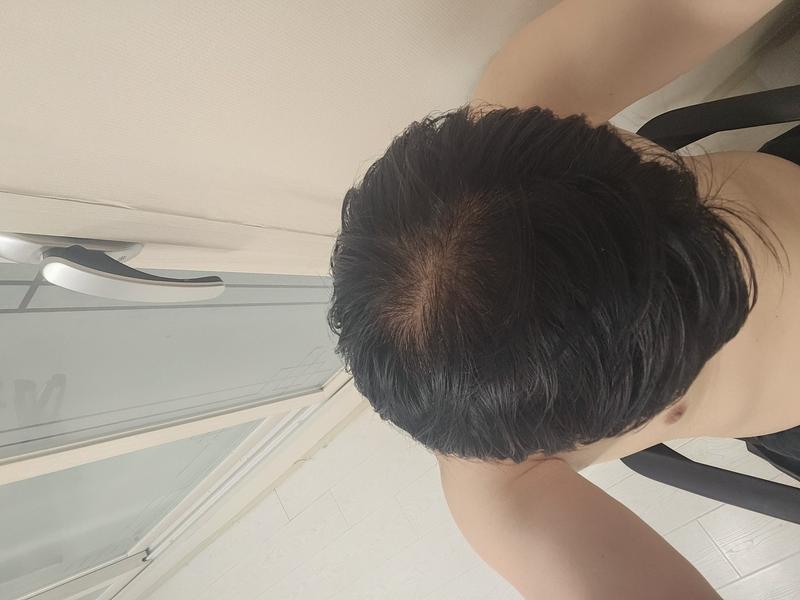 탈모약 복용 2주차...