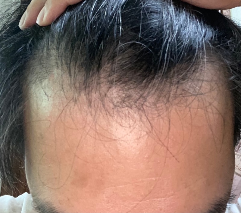 克服脱发？后期