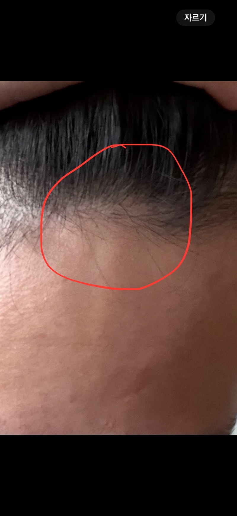 가르마부분 헤어라인 탈모 질문