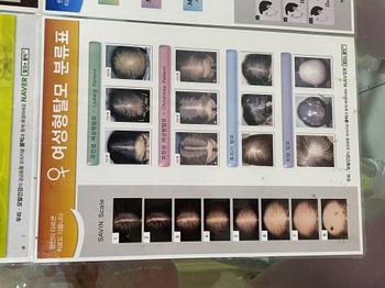여성형 정수리 탈모 단계별 경과