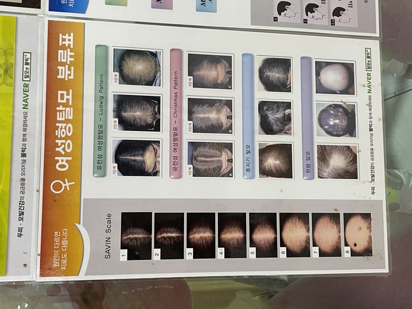 병원에 붙어 있는 여성형 탈모 단계
