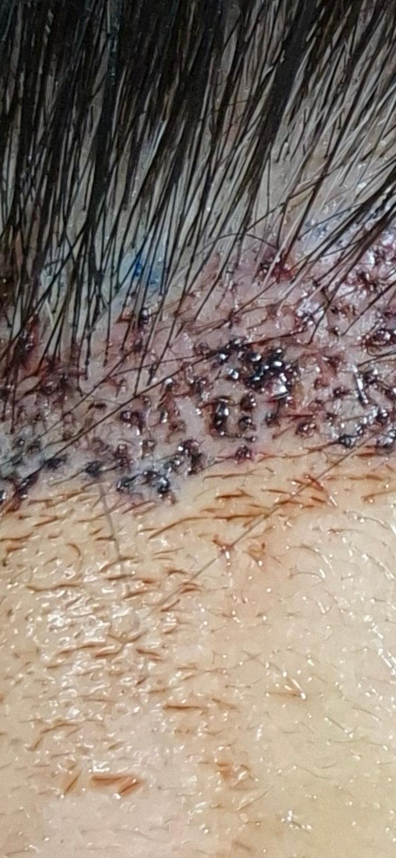 I had a hair transplant, so what are the little hairs?