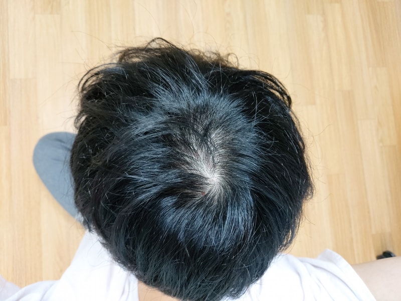 핀페 효과 못봐서 두타 카피약으로 넘어갓는데