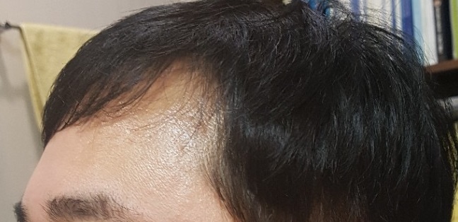 두타1달 복용중