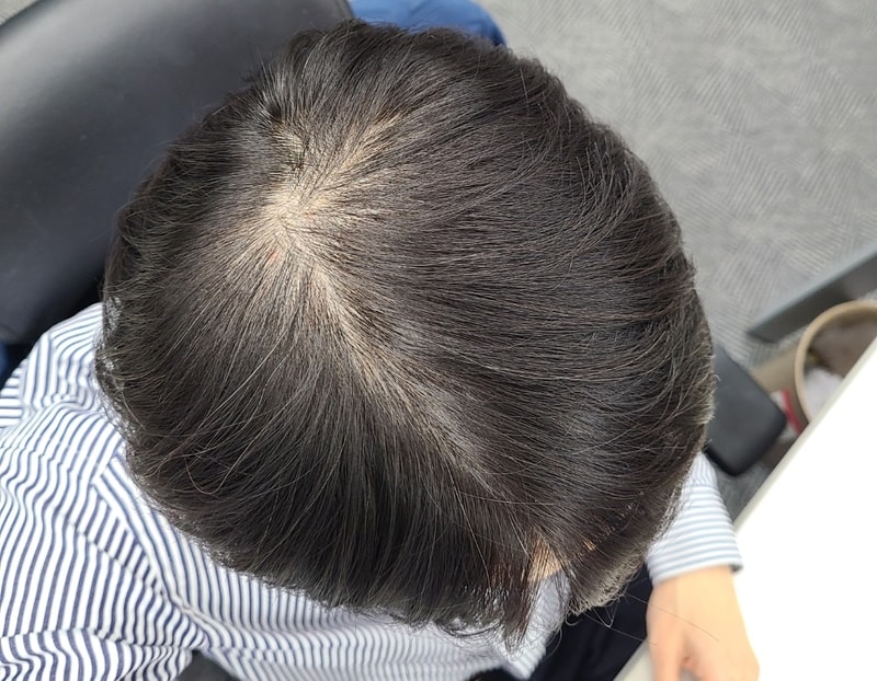 이제야 핀페시아 미녹시딜 시작합니다