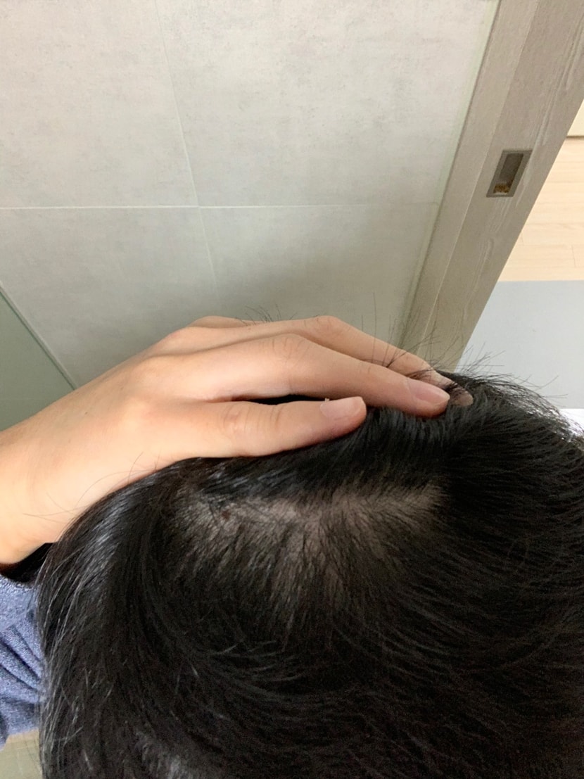 정수리 앞을 제외한 부분입니다. 다른 부분들은 머리가 괜찮네요