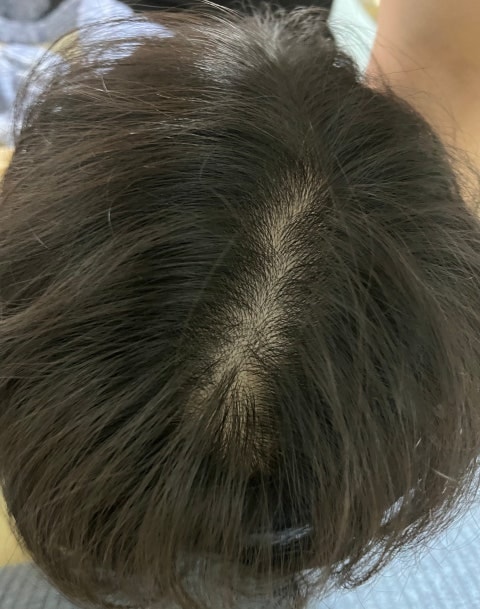 이소티논 복용 전 사진