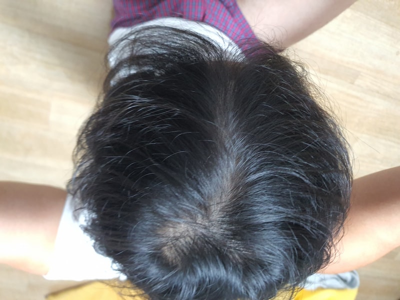 제가 무슨 탈모 증상일까요??