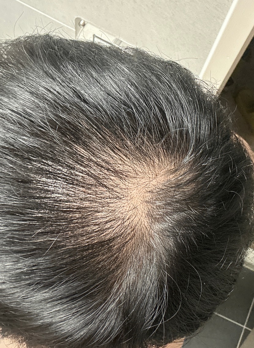 3개월차 (복용전보다 약간 더 빠진듯)