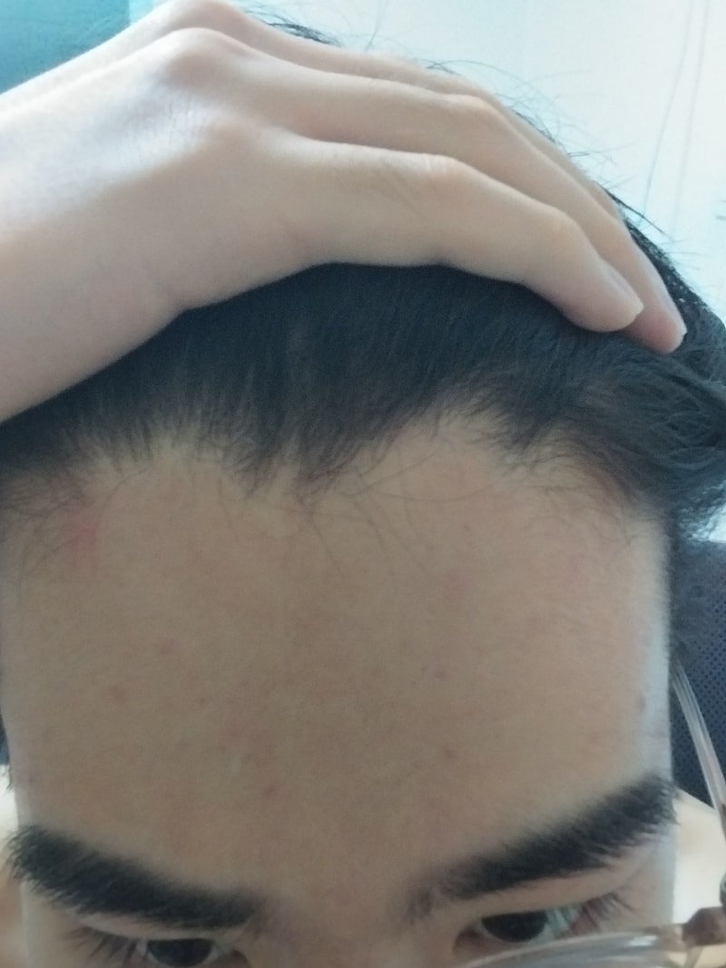안녕하세요! 탈모인지 혹시 봐주실 수 있으신가요 ㅠㅠㅠ