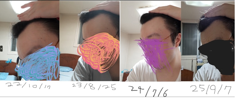 왼쪽 이마라인