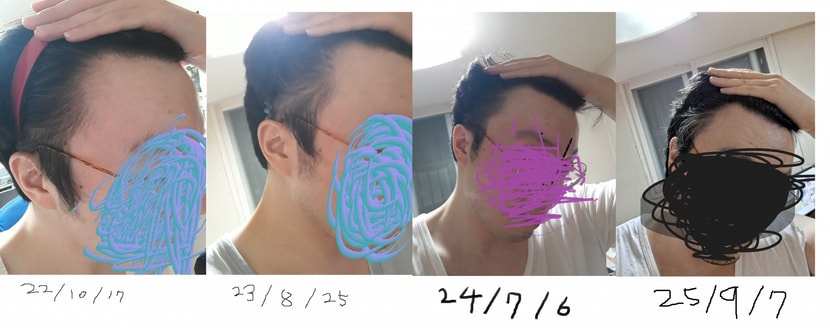 오른쪽 이마라인