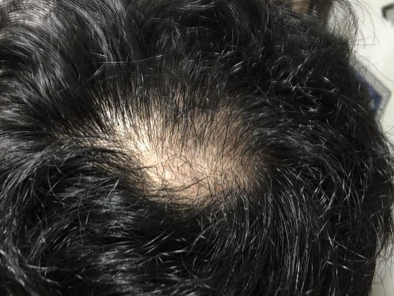 피나스테리드+미녹시딜 4개월 후기입니다