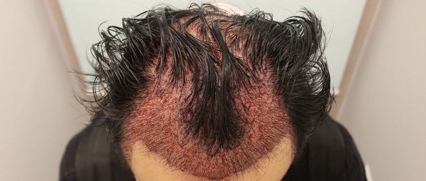 모발이식 직후