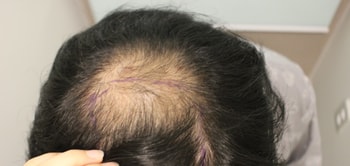 모발이식 전 탈모상태2
