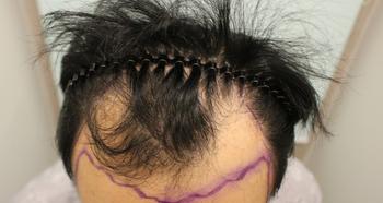 모발이식 전 탈모상태1