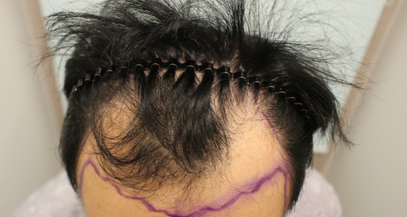 모발이식 전 탈모상태1