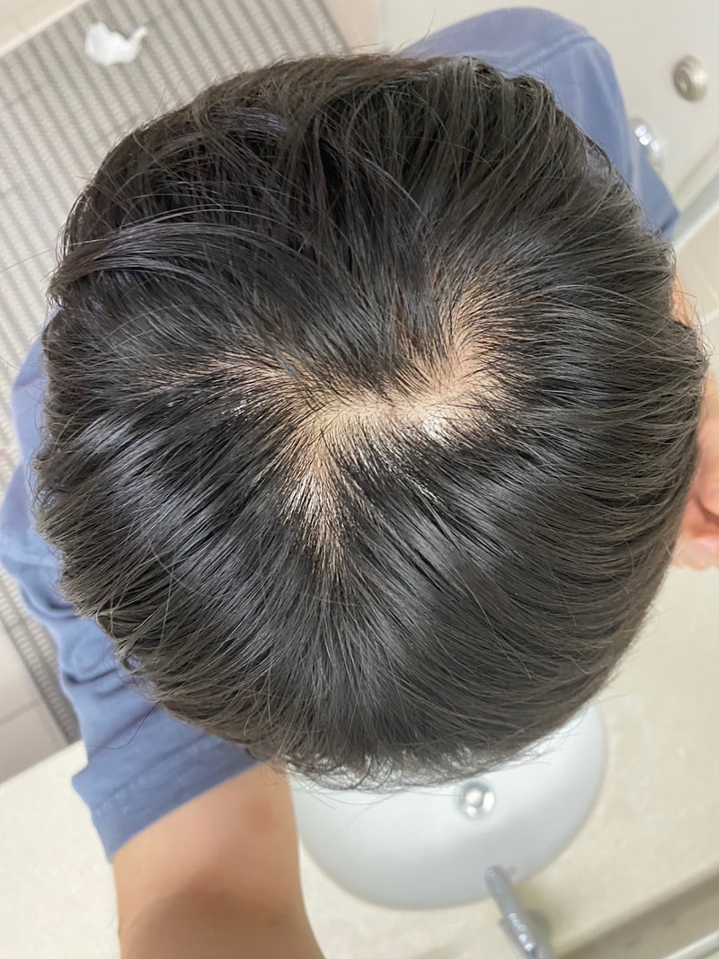 头顶因为脱发而变得很美味。