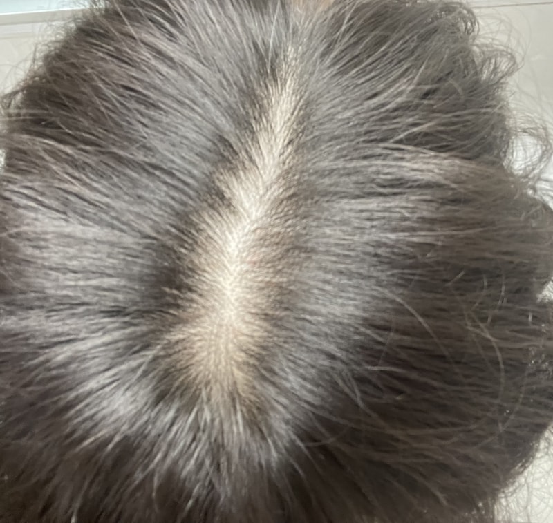 약 복용 3년차 상황