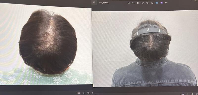 대구모발이식 불안에서 안도감으로.. (아보다트 복용중)