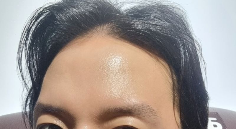 수술전