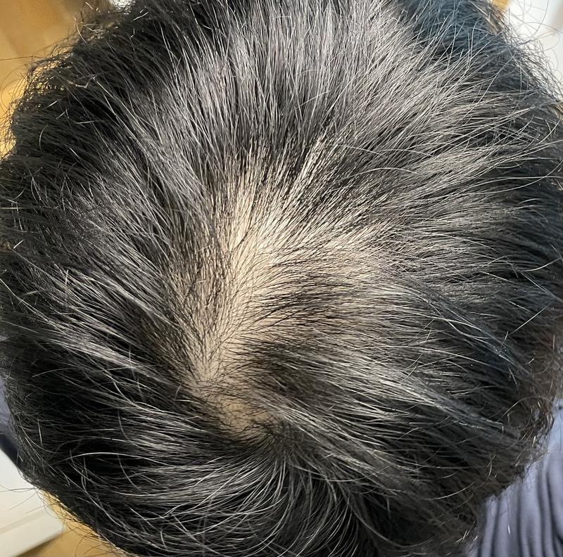 AGA治療薬飲んでないからうつ病になります;;