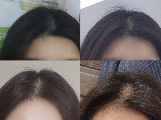 관리하고 좋아진 후에 소홀해지자 다시 빠짐