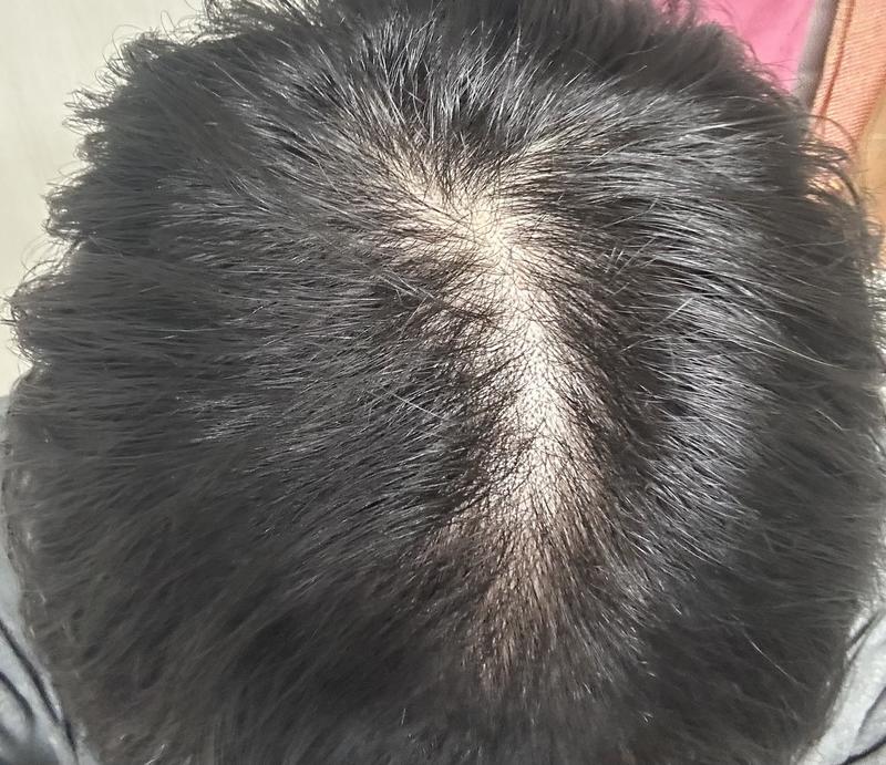 頭頂部の脱毛ですか