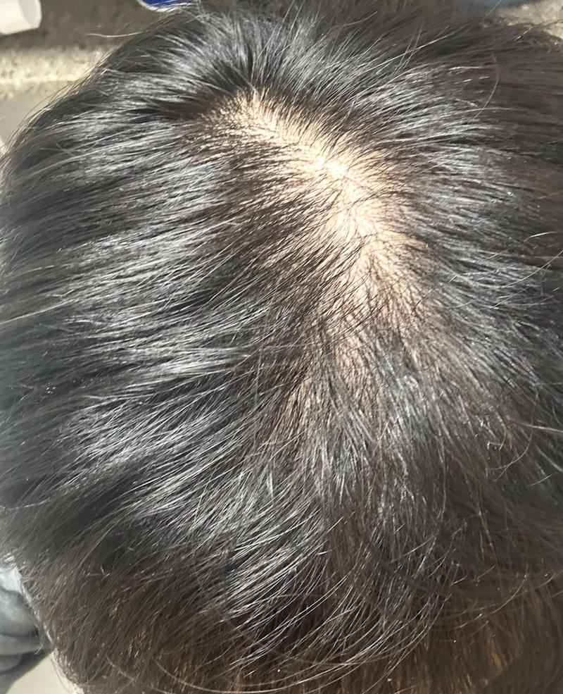 頭頂部の薄毛ですか？ 専門家の方々
