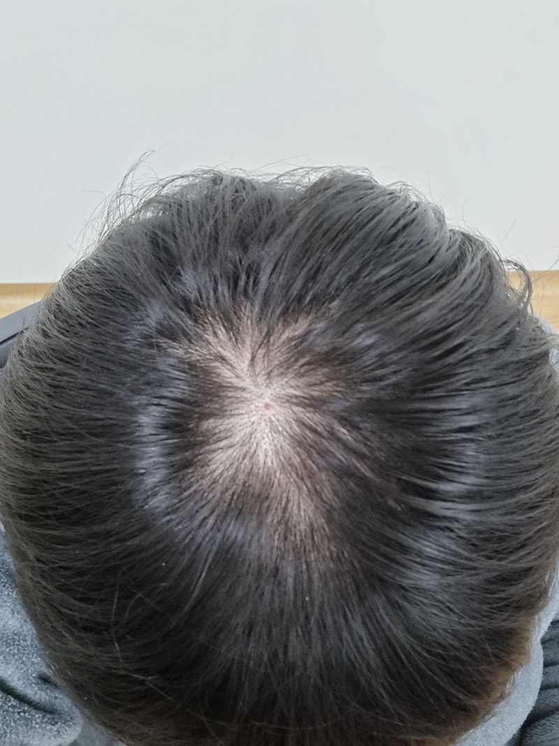 약 5년 복용 정수리 탈모 심각한 수준까지 왔내요.