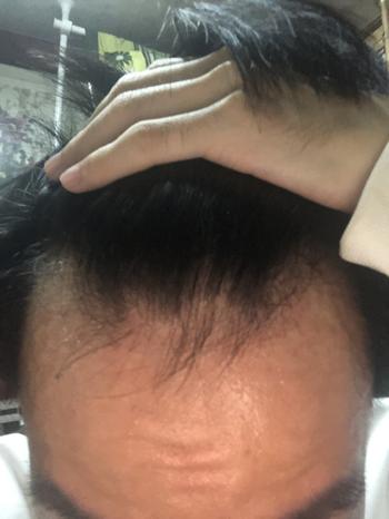 탈모약 아예 섭취 안하던때