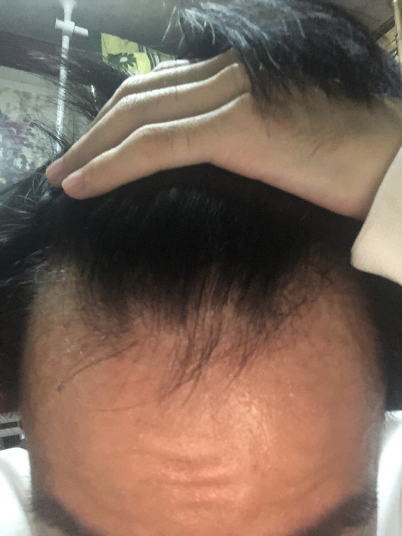탈모약 아예 섭취 안하던때