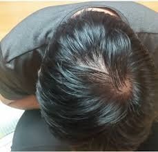 탈모약 복용 전 후 비교사진 보여드림 (약간 드라마틱함)