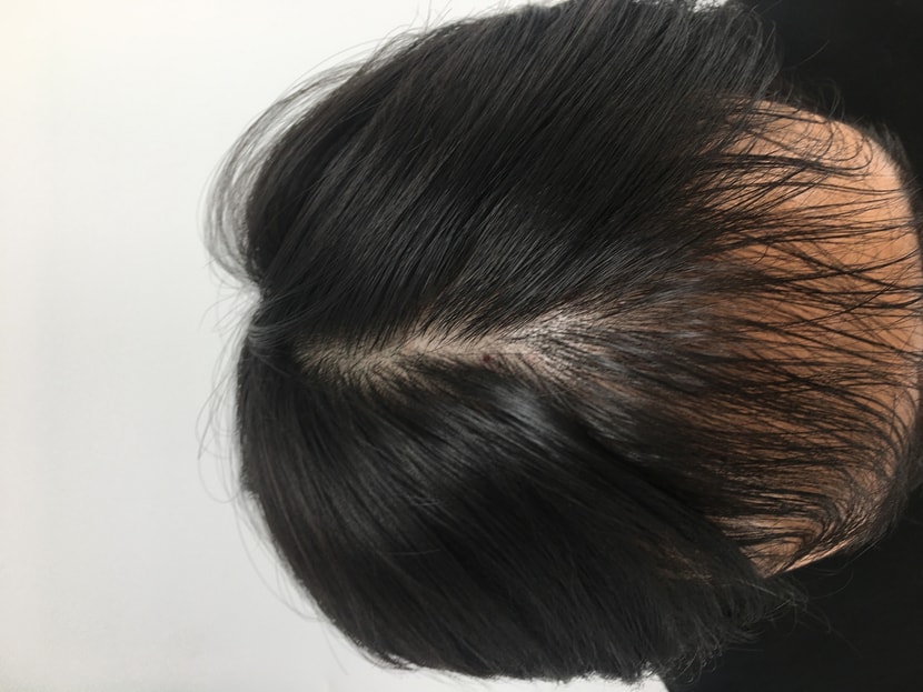 비어가는 정수리