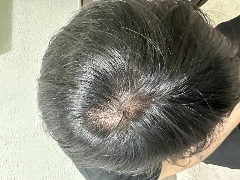 프로페시아 4년 복용 - > 아보다트 1년복용 후기