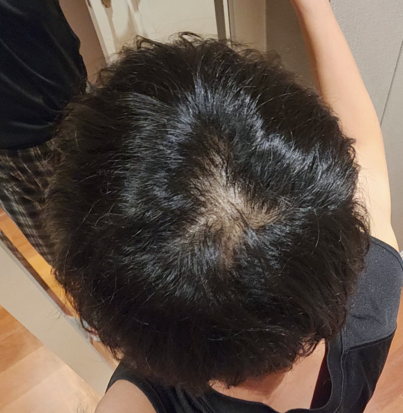 탈모약 먹어야 할거같네요