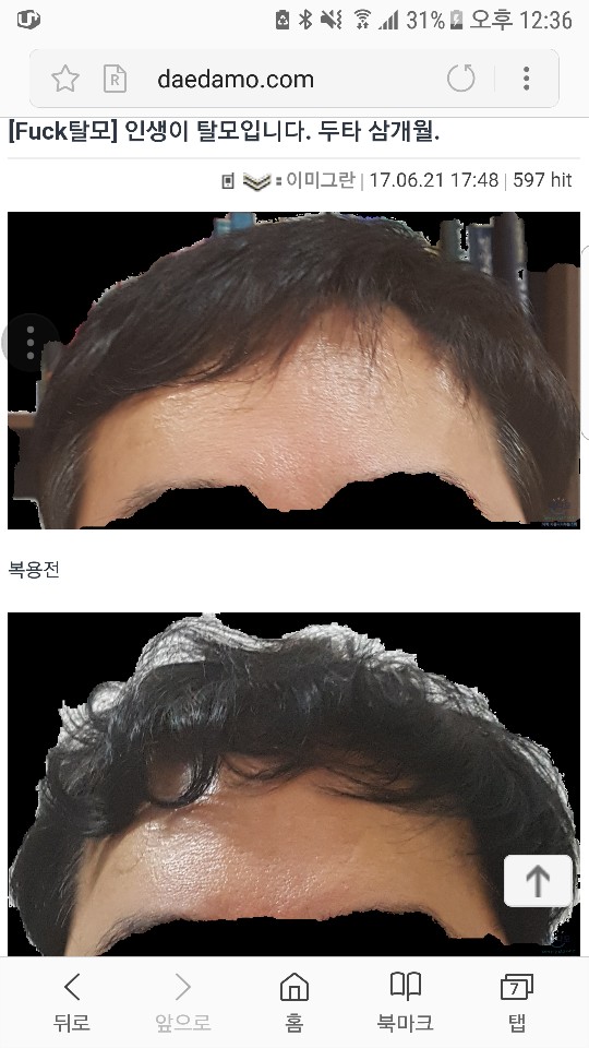 두타복용전과 삼개월 사진