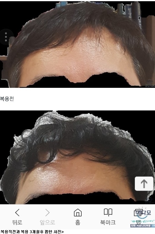 복용전과 3개월 복용후 펌한 사진