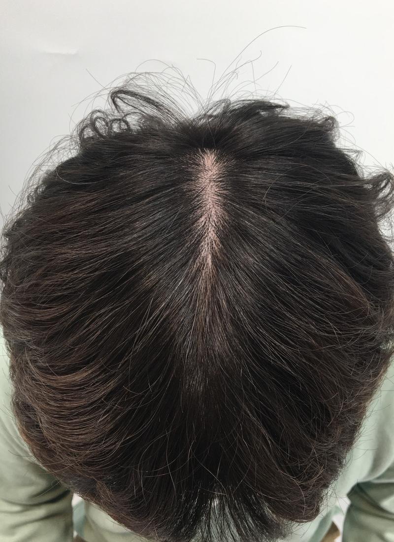 开始治疗外泌体+肉毒杆菌