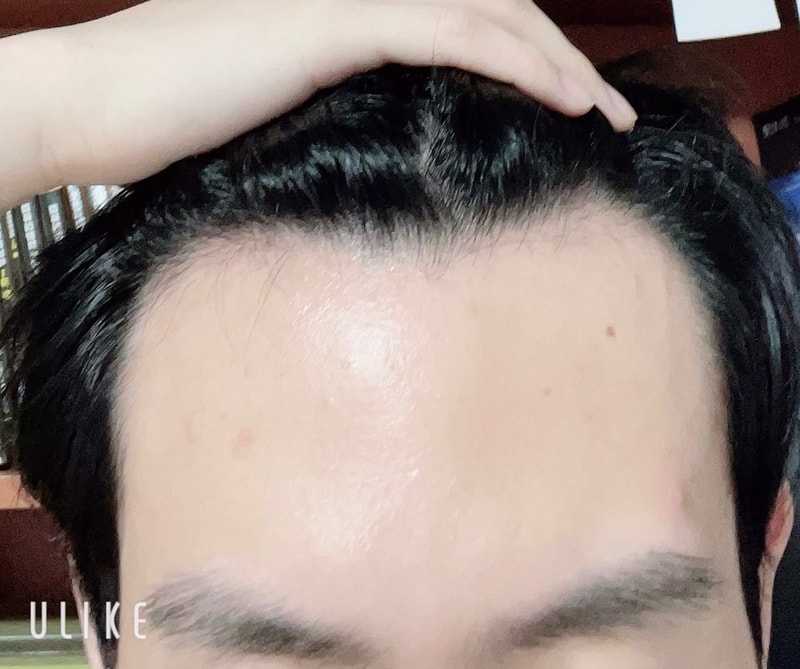 이마라인 내린다 vs 안내린다