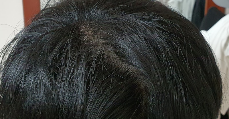 后脑脱发也是头顶脱发的一种吗？