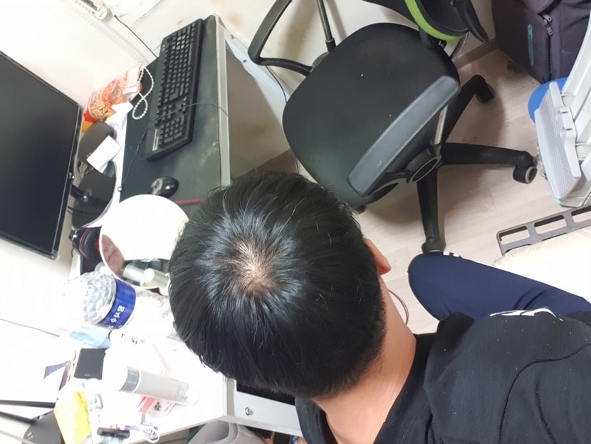 탈모약7개월차