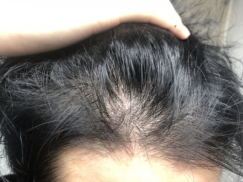 아보다트 1개월 10일 후기