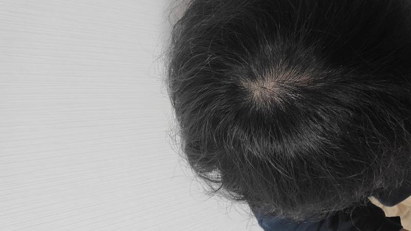 판시딜+피나 복용기록용