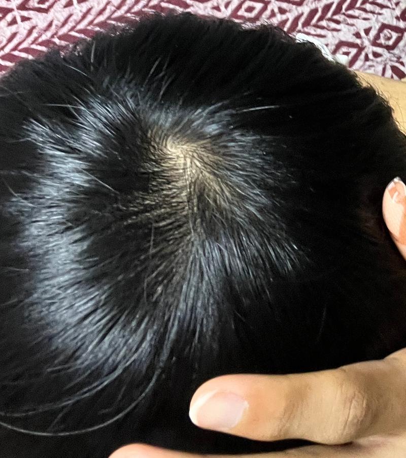 1년 8개월정도 지난 사진인데 탈모 맞을까요?