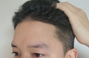 비절개슬릿 4개월차 (염색 전)