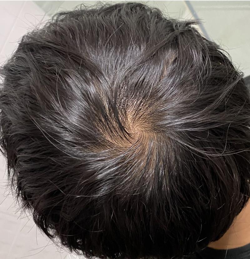 거의 4-5년만에 다시 들어와보네요.. 29살 탈모 어때보이나요